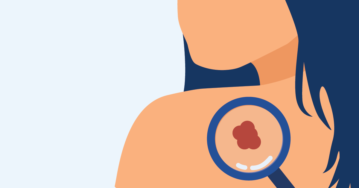 Free Skin Cancer Screenings In May
